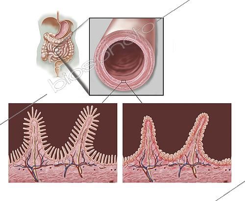 Biosphoto | 2475707 | Cross section of intestine showing destruction of villi due to celiac disease. | &copy; Elise Walmsley-MacWha / Stocktrek Images / Biosphoto